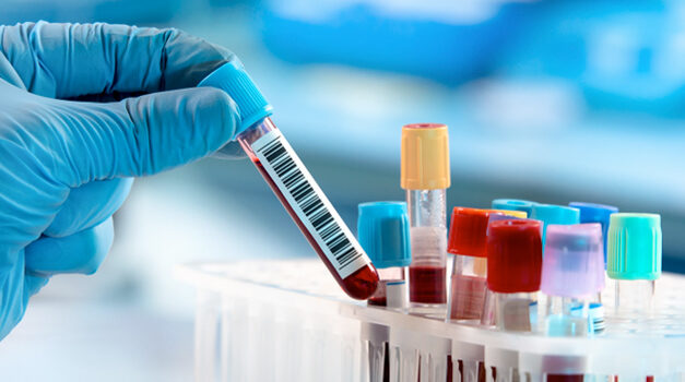 Test di laboratorio per gli anticoagulanti orali diretti (DOACs): quando sono utili?