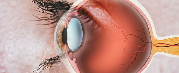 La SISET fornisce indicazioni sul trattamento dell’occlusione venosa retinica