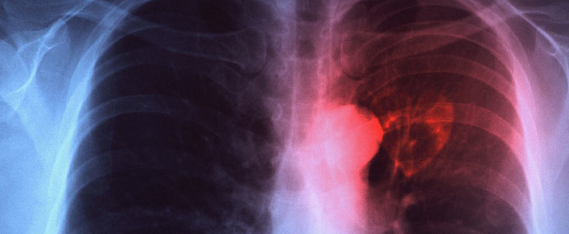 COPE studia la mortalità dell’embolia polmonare