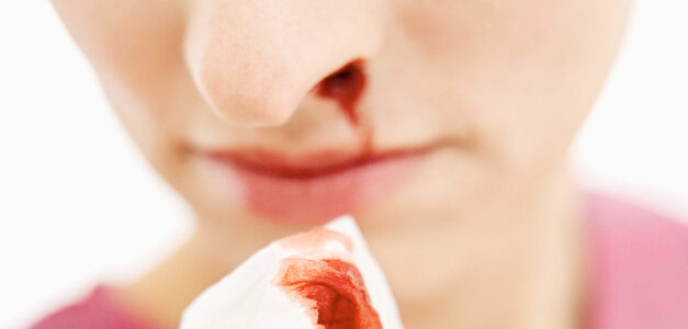 Sangue dal naso: che cosa fare