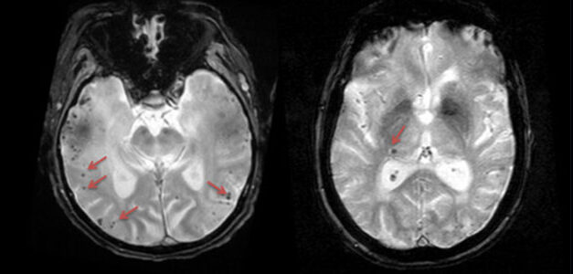 Un fattore di rischio di emorragia cerebrale in pazienti anticoagulati: le “microbleeds”